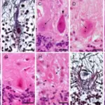 Spinocerebellar Ataxia