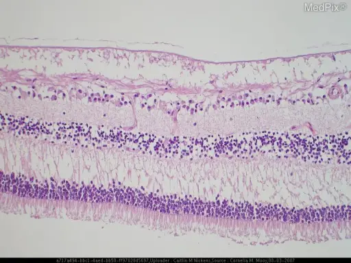 Spinocerebellar Degenerations