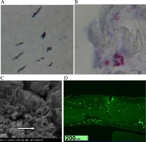 Spirochete Bacterial Infections