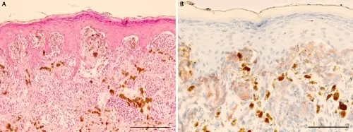 Spitz Nevus