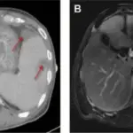 Splenic Infarcts