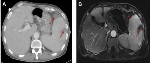 Splenic Infarcts