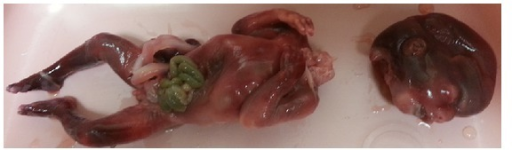 Spontaneous Abortion