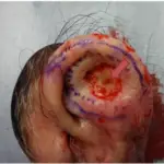 Squamous Cell Carcinoma of the Ear