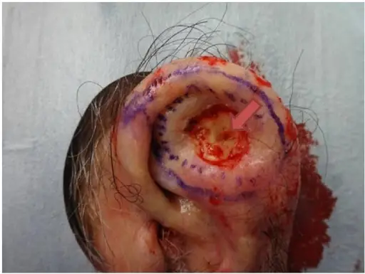 Squamous Cell Carcinoma of the Ear