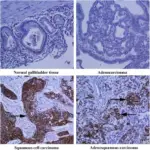 Squamous Cell Carcinoma of the Gallbladder