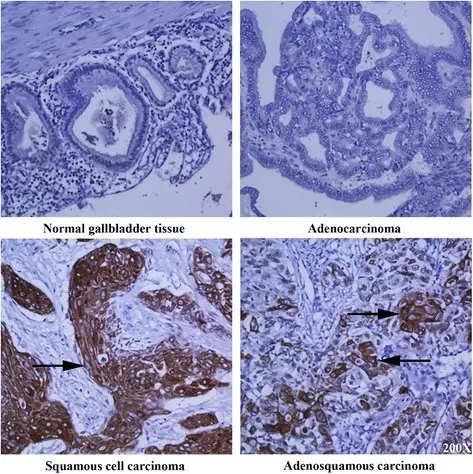 Squamous Cell Carcinoma of the Gallbladder