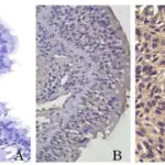 Squamous Cell Carcinoma of the Lung