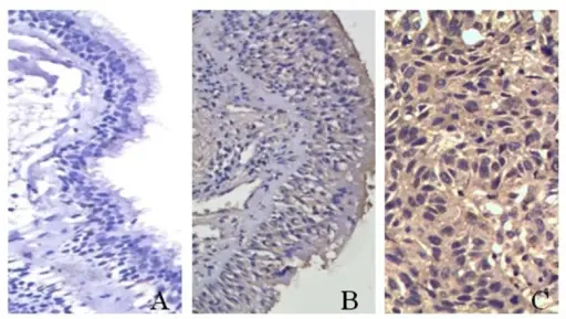 Squamous Cell Carcinoma of the Lung