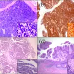 Squamous Cell Carcinoma of the Penis