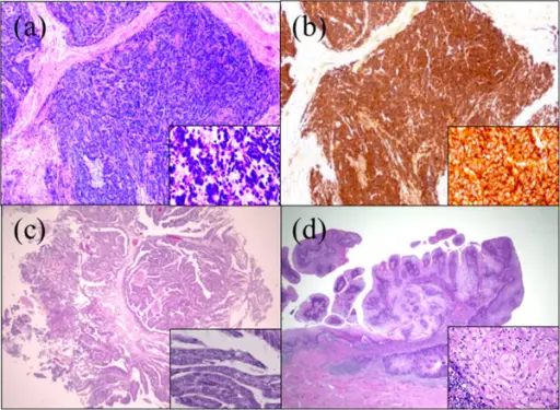 Squamous Cell Carcinoma of the Penis