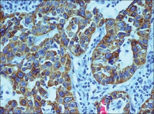 Squamous Cell Carcinoma of the Salivary Gland