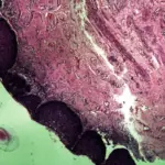Squamous Cell Carcinoma of the Vagina