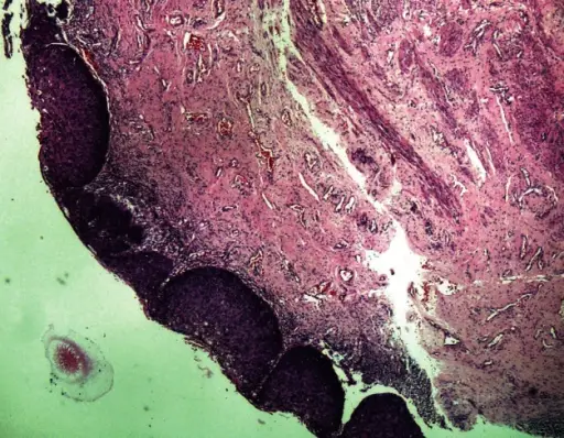 Squamous Cell Carcinoma of the Vagina