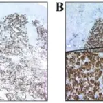 Squamous Cell Hyperplasia of the Vulva