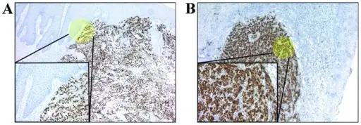 Squamous Cell Hyperplasia of the Vulva