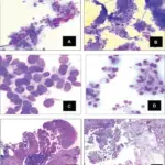 Squamous Metaplasia of Lactiferous Ducts