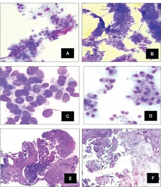 Squamous Metaplasia of Lactiferous Ducts