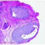 Squamous Odontogenic Tumor