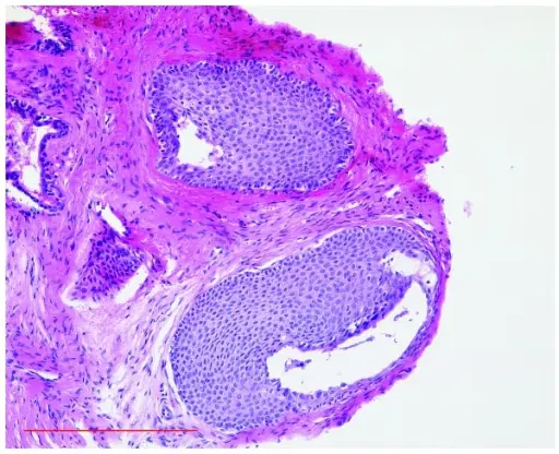 Squamous Odontogenic Tumor