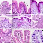 Stomach Metaplasia