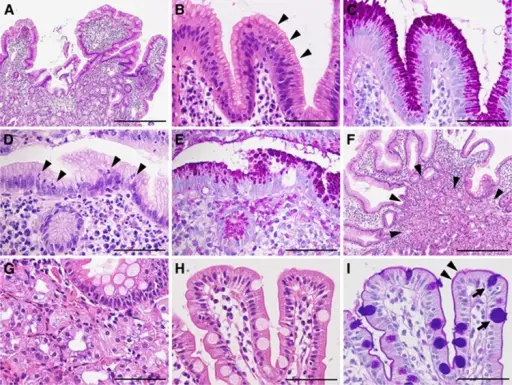 Stomach Metaplasia