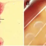 Streptococcal Bacterial Infection