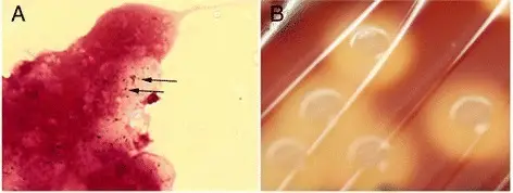 Streptococcal Bacterial Infection