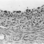 Stromal Hyperthecosis