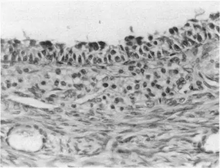 Stromal Hyperthecosis