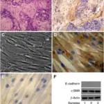 Stromal Tumors of the Breast