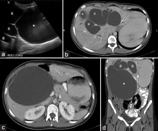 Structural Anomalies of the Biliary Tree