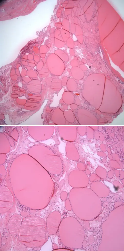 Struma Ovarii Teratomas