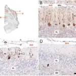 Subacute Cerebellar Degeneration