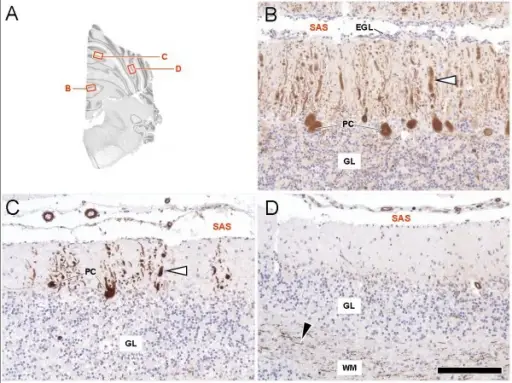 Subacute Cerebellar Degeneration