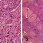 Subacute Lymphocytic Thyroiditis