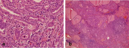 Subacute Lymphocytic Thyroiditis