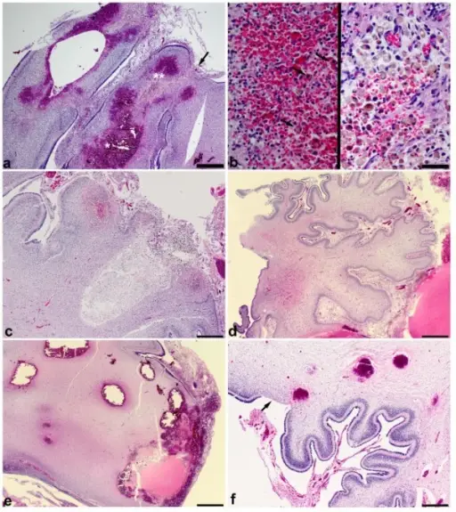 Subacute Neuronal Injury