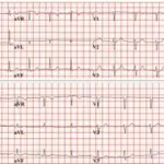 Sudden Cardiac Death