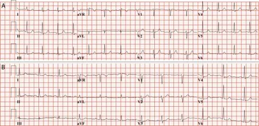 Sudden Cardiac Death