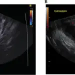 Suppurative Salpingitis