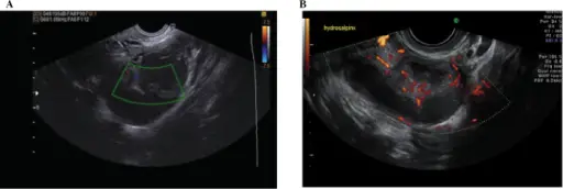 Suppurative Salpingitis