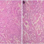 Surfactant Dysfunction Disorders that Cause Restrictive Lung Diseases