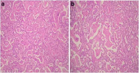 Surfactant Dysfunction Disorders that Cause Restrictive Lung Diseases