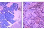 Susceptibility Genes