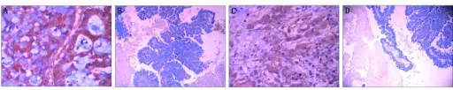 Susceptibility Genes