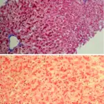 Syndromes of Viral Hepatitis