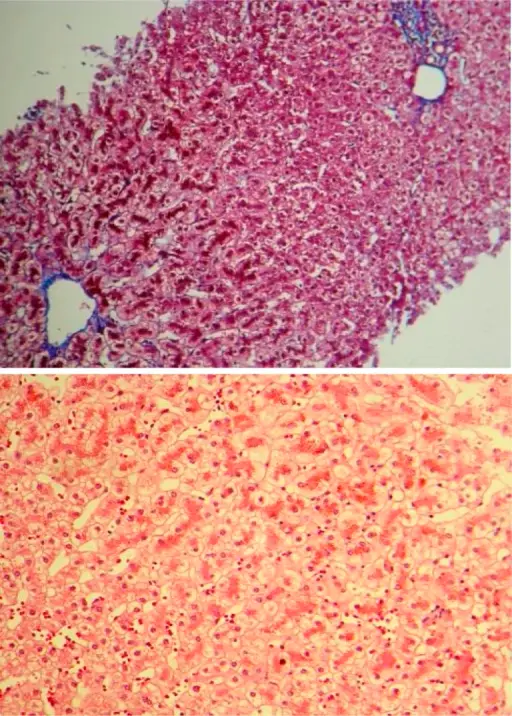 Syndromes of Viral Hepatitis