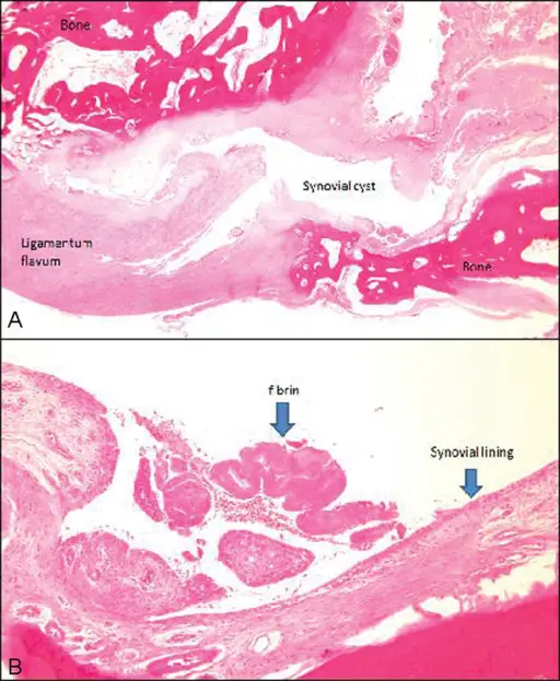 Synovial Cysts