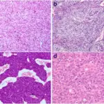 Synovial Sarcoma